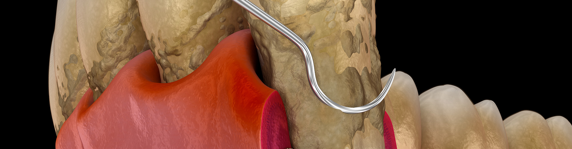 rendering of dental tool removing plaque from teeth.